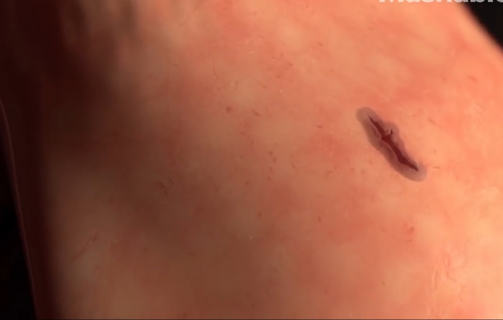 Seal Wounds in 60 Seconds Without the Stitching
