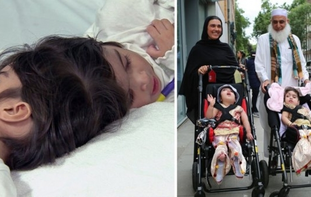 Twins conjoined at the head are separated after 50 hours of surgery