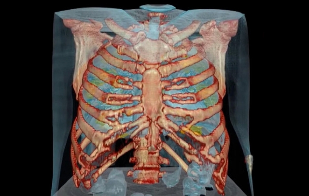 Video reveals lung damage in US coronavirus patient: 'People need to take this seriously'