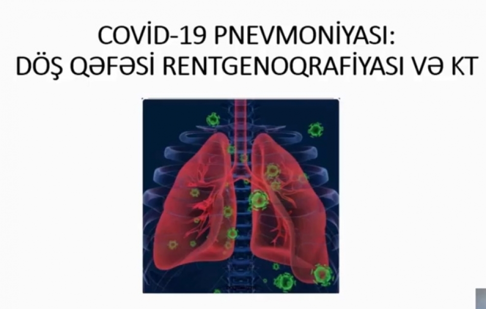 Azərbaycanlı radioloq COVİD-19-la bağlı elmi nəticələri açıqladı