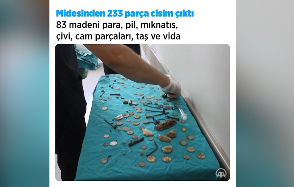 Mədəsindən 233 ədəd yad cisim çıxarılan şəxs