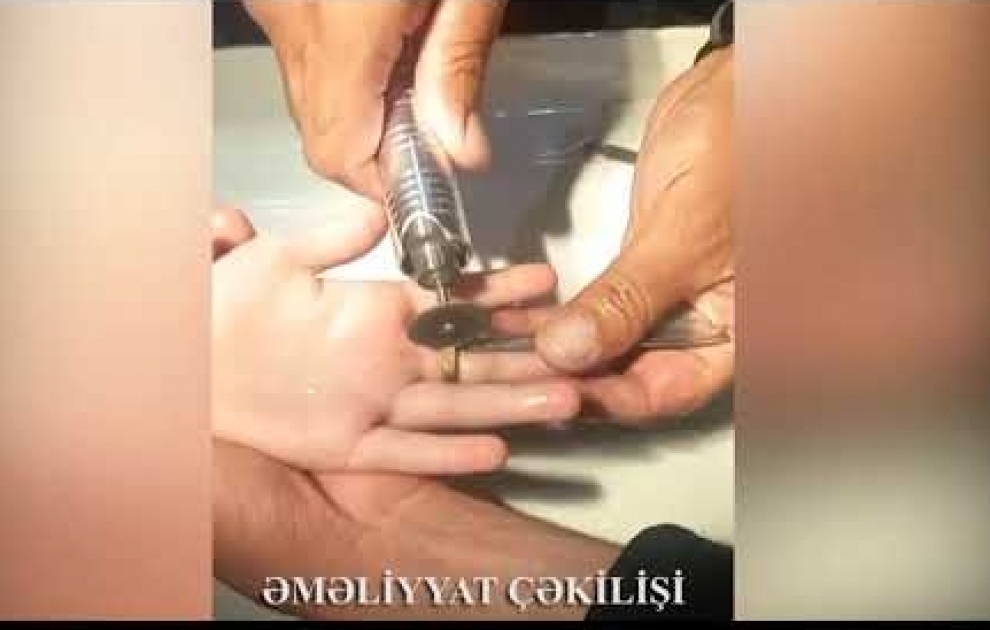 Barmağında dəmir halqa qalan azyaşlıya yardım edildi